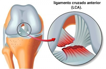 Lesiones del ligamento cruzado anterior (LCA).